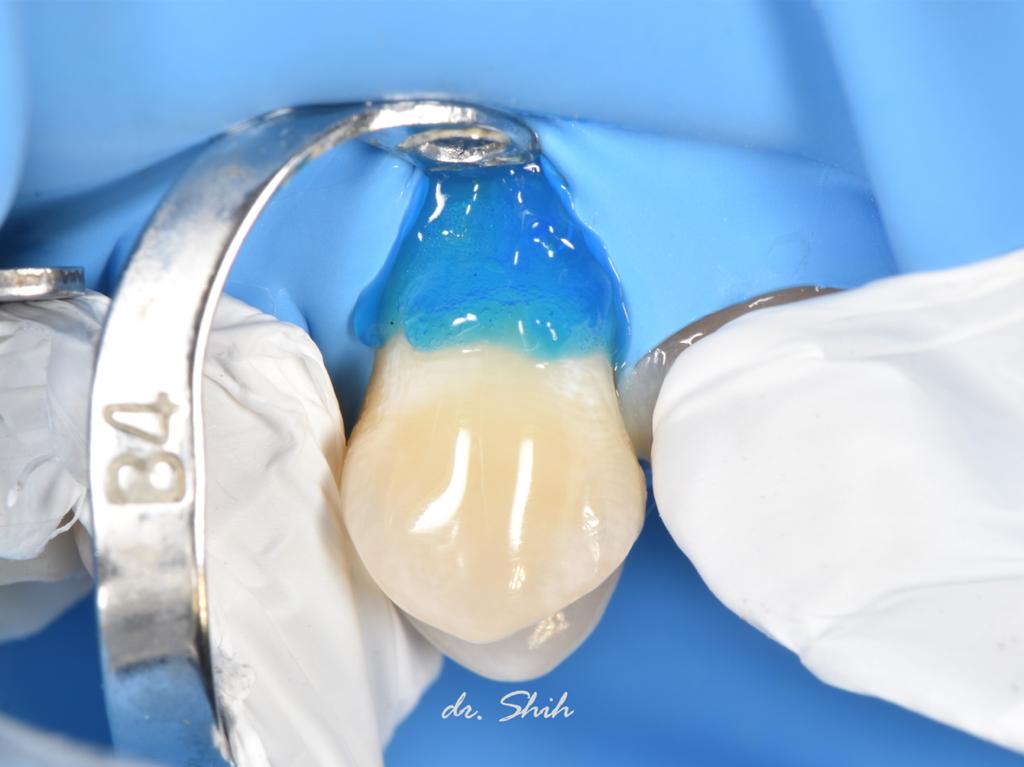 i-GEL_dr_Shih_2